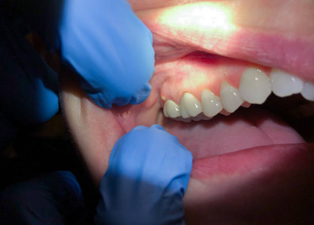 Best Emergency Treatment for Oral Infections in Helena, AL